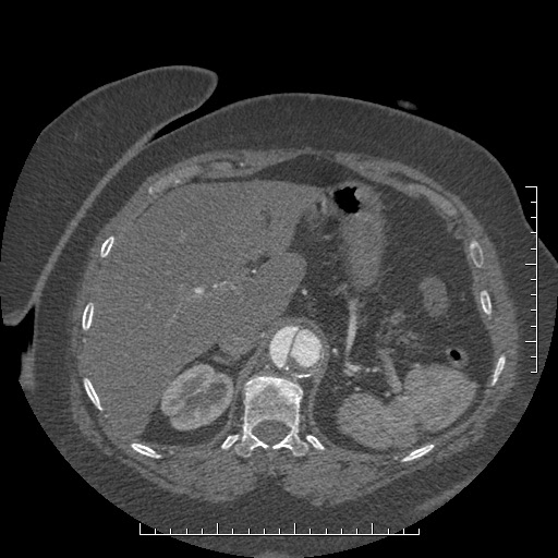 Aortic dissection- Stanford A (Radiopaedia 35729-37268 B 37).jpg