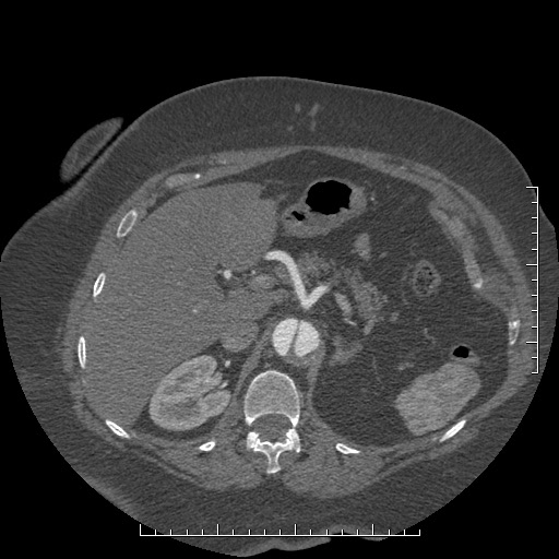 Aortic dissection- Stanford A (Radiopaedia 35729-37268 B 46).jpg