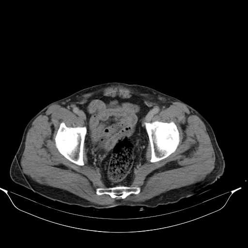 File:Aortic dissection- Stanford type A (Radiopaedia 22085-22085 Axial C+ delayed 48).jpg