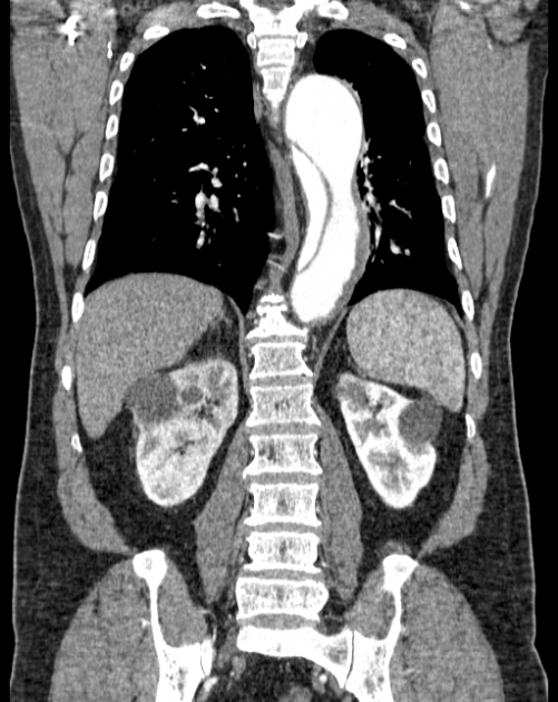 Aortic dissection (Radiopaedia 44411-48061 A 43).jpg