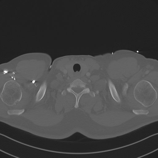 File:Aortic dissection (Radiopaedia 50763-56234 Axial bone window 7).png