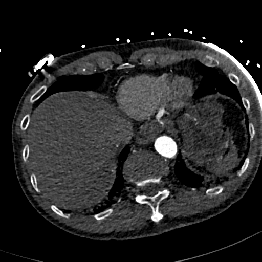 File:Aortic dissection - DeBakey type II (Radiopaedia 64302-73082 A 76).png