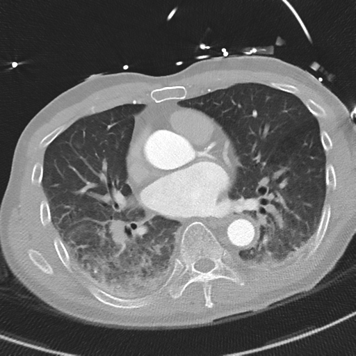 Aortic dissection - DeBakey type II (Radiopaedia 64302-73082 Axial lung window 34).png
