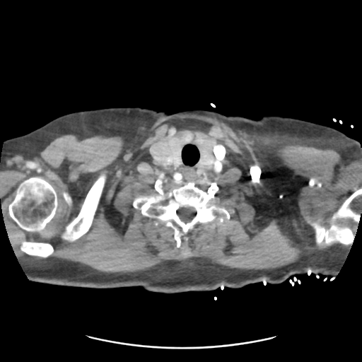 File:Aortic dissection - Stanford type B (Radiopaedia 50171-55512 A 2).png