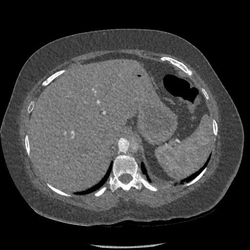 Aortic dissection - Stanford type B (Radiopaedia 88281-104910 A 90).jpg