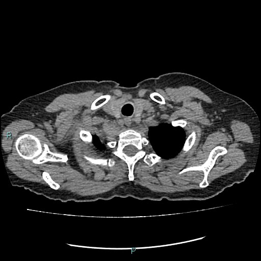 File:Aortic dissection extended to lusory artery (Radiopaedia 43686-47136 Axial non-contrast 3).jpg