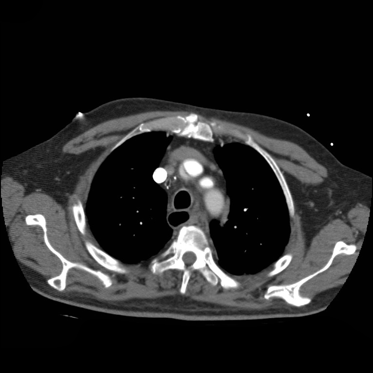 Aortic dissection with rupture into pericardium (Radiopaedia 12384-12647 A 14).jpg