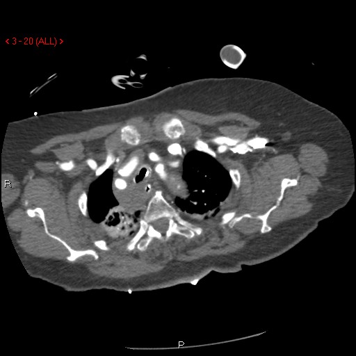 Aortic intramural hematoma (Radiopaedia 27746-28001 A 20).jpg