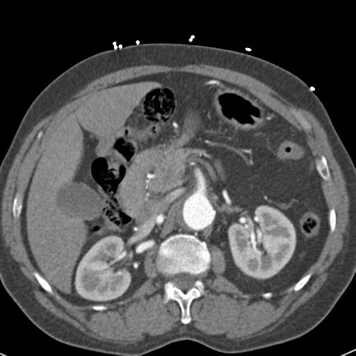 Aortic intramural hematoma (Radiopaedia 31139-31838 B 95).jpg