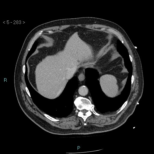 Aortic intramural hematoma (Radiopaedia 48463-53380 C 127).jpg