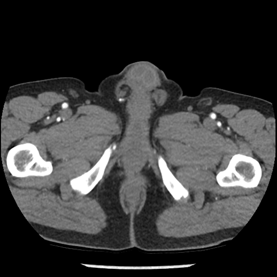 Aortic intramural hematoma (type B) (Radiopaedia 79323-92387 B 125).jpg