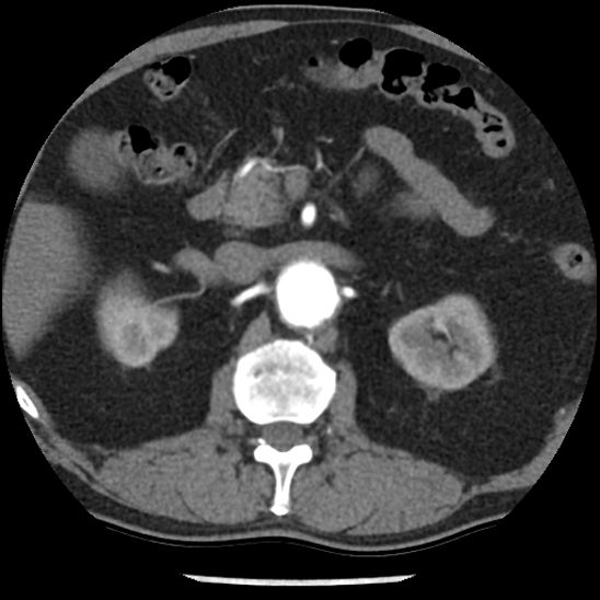 Aortic intramural hematoma (type B) (Radiopaedia 79323-92387 B 64).jpg