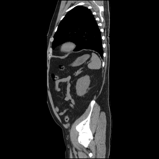 Aortic intramural hematoma (type B) (Radiopaedia 79323-92387 G 44).jpg