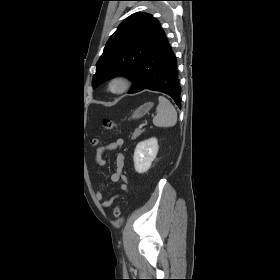 Aortic intramural hematoma (type B) (Radiopaedia 79323-92387 Sagittal C+ delayed 45).jpg