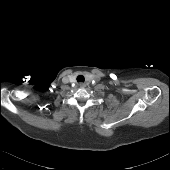 Aortic intramural hematoma with dissection and intramural blood pool (Radiopaedia 77373-89491 B 21).jpg