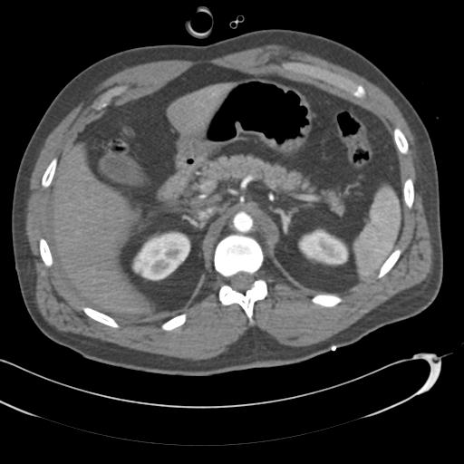 Aortic transection, diaphragmatic rupture and hemoperitoneum in a complex multitrauma patient (Radiopaedia 31701-32622 A 92).jpg