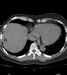 Aortic valve endocarditis (Radiopaedia 87209-103485 Axial non-contrast 76).jpg