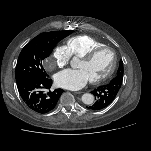 File:Aorto-coronary bypass graft aneurysms (Radiopaedia 40562-43157 A 76).png