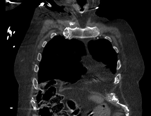 Aortoesophageal fistula with endovascular repair (Radiopaedia 73781-84592 Coronal C+ CTPA 15).jpg