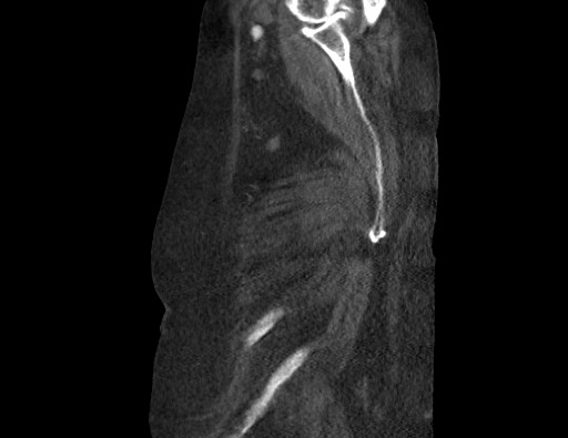 Aortoesophageal fistula with endovascular repair (Radiopaedia 73781-84592 Sagittal C+ CTPA 194).jpg