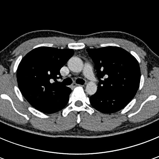 Apical lung mass mimic - neurogenic tumor (Radiopaedia 59918-67521 A 31).jpg