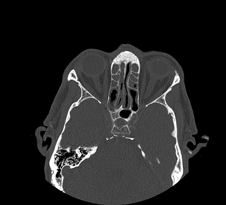 Aplastic maxillary sinuses (Radiopaedia 60030-67561 Axial non-contrast 49).jpg