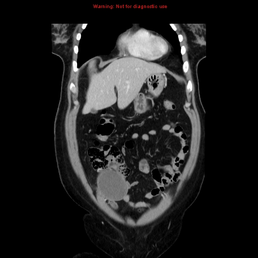 Appendiceal mucinous cystadenoma (Radiopaedia 8263-9111 B 18).jpg