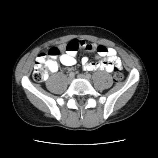 File:Appendicitis complicated by post-operative collection (Radiopaedia 35595-37113 A 50).jpg