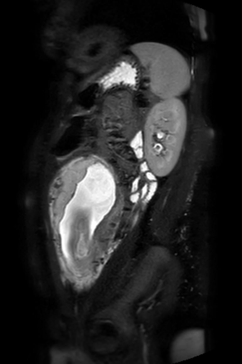 Appendicitis in gravida (MRI) (Radiopaedia 89433-106395 Sagittal T2 SPAIR 18).jpg