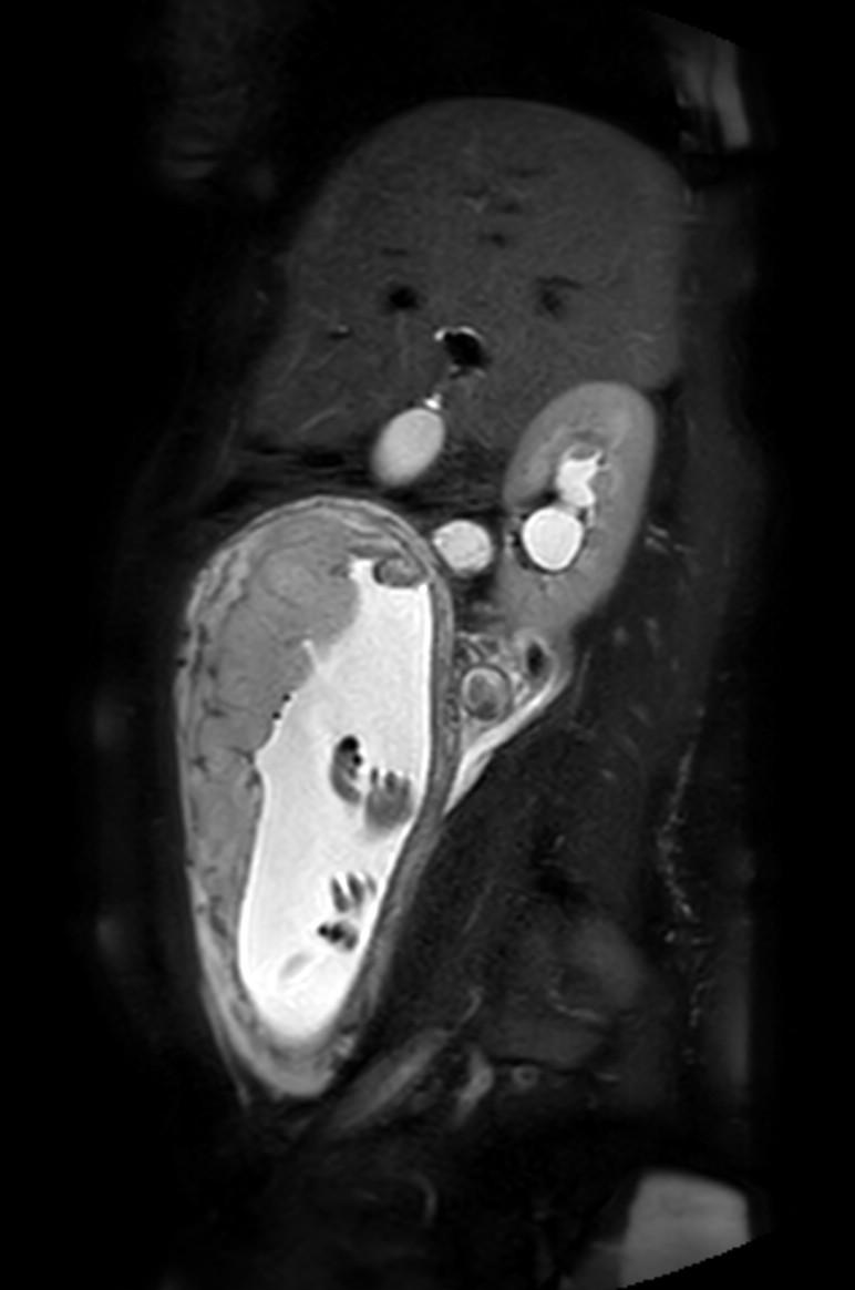 Appendicitis in gravida (MRI) (Radiopaedia 89433-106395 Sagittal T2 SPAIR 42).jpg