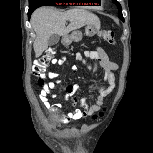 File:Appendicitis mass in inguinal hernia (Radiopaedia 26858-27029 B 16).jpg
