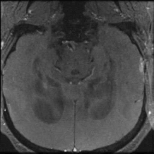 Aqueduct stenosis with corpus callosum hypoattenuation post shunting (Radiopaedia 37212-38969 Axial CSF Flow 64).png