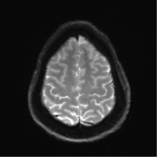 Arachnoid cyst - cerebellopontine angle (Radiopaedia 59689-67083 Axial DWI 30).png