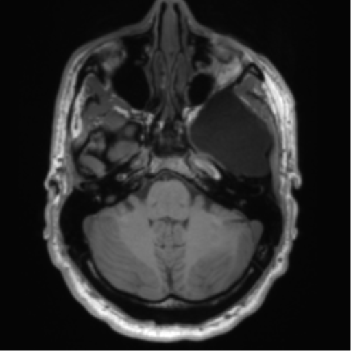File:Arachnoid cyst with subdural hematoma (Radiopaedia 85892-101743 Axial T1 23).png