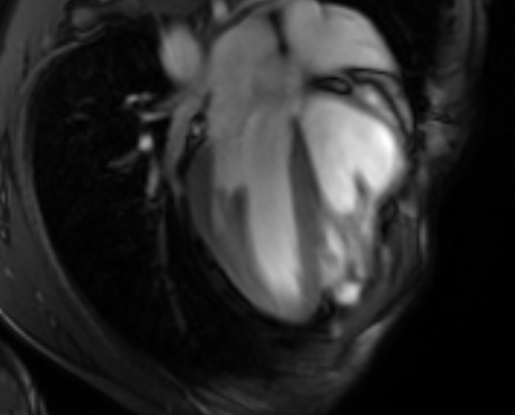 File:Arrhythmogenic right ventricular cardiomyopathy (Radiopaedia 69564-79464 4ch cine 47).jpg