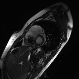Arrhythmogenic right ventricular cardiomyopathy (Radiopaedia 87505-103850 short axis Cine SSFP 207).jpg