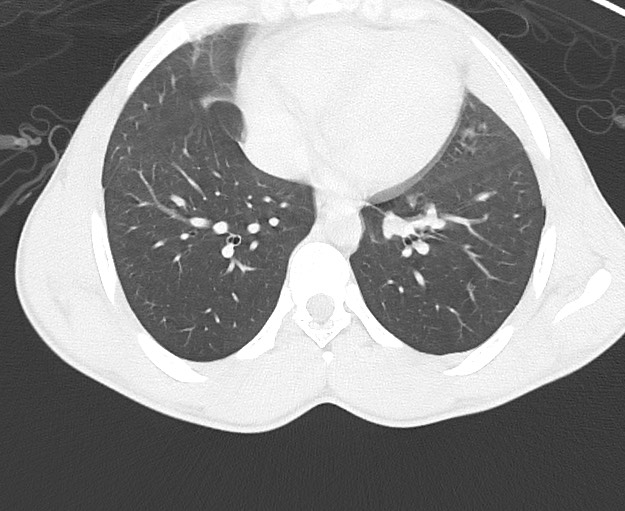 Arrow injury to the chest (Radiopaedia 75223-86321 Axial lung window 58).jpg