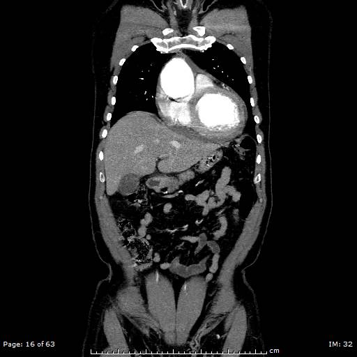 Ascending aortic aneurysm (Radiopaedia 50086-55404 B 16).jpg