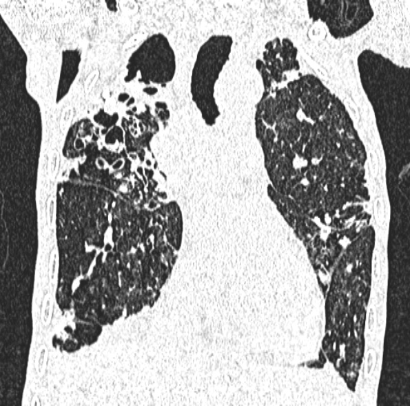 Aspergilloma- with Monod sign (Radiopaedia 44737-48532 Coronal lung window 219).jpg