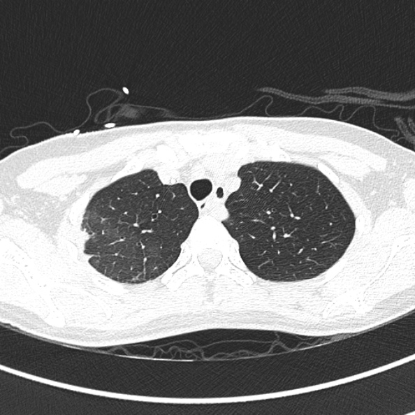Aspergilloma (Radiopaedia 26223-26347 Axial lung window 16).jpg