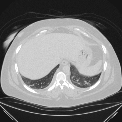 Aspergilloma (Radiopaedia 39611-41932 Axial lung window 116).jpg