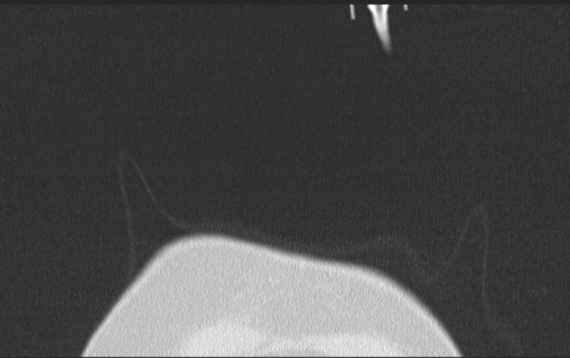 Aspirated tooth (Radiopaedia 28584-28844 Axial lung window 10).jpg