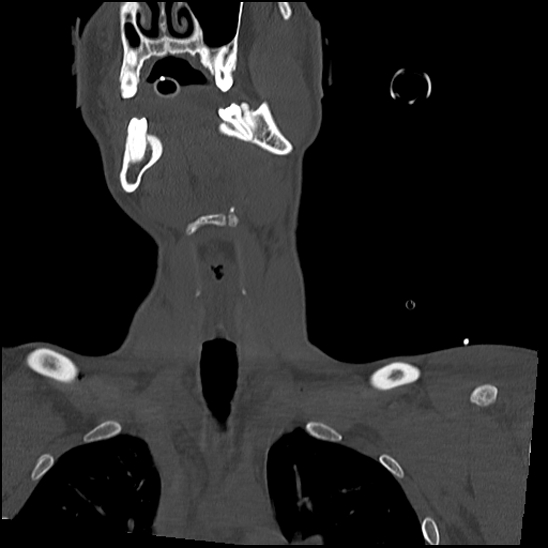 Atlanto-occipital dissociation (Traynelis type 1), C2 teardrop fracture, C6-7 facet joint dislocation (Radiopaedia 87655-104061 Coronal bone window 17).jpg