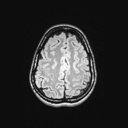 Atretic encephalocoele with inferior vermis hypoplasia (Radiopaedia 30443-31108 Axial 122).jpg