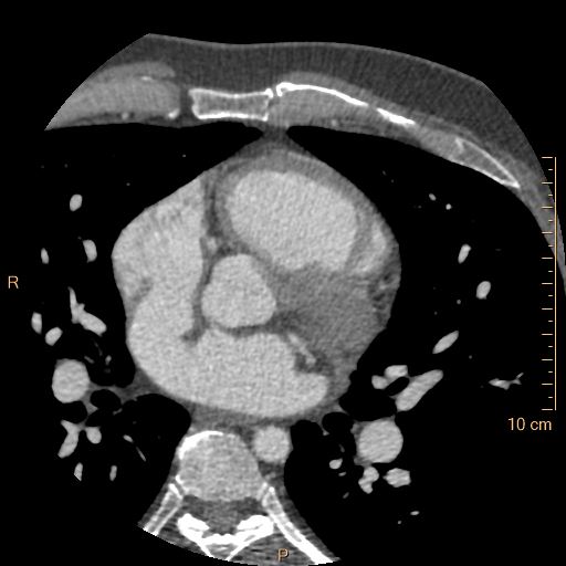 Atrial septal defect (upper sinus venosus type) with partial anomalous pulmonary venous return into superior vena cava (Radiopaedia 73228-83961 A 108).jpg