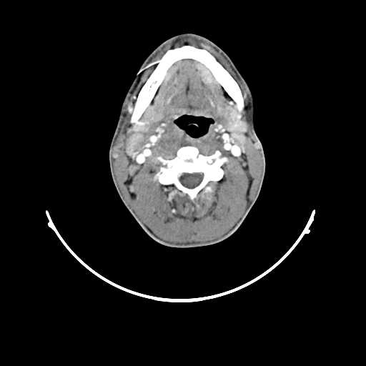 File:Atypical 2nd branchial cleft cyst (type IV) - infected (Radiopaedia 20986-20924 A 12).jpg