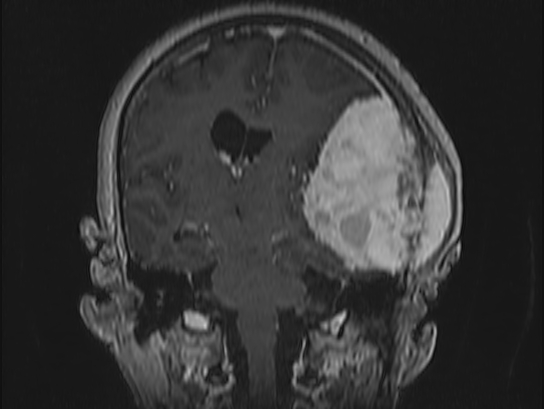 Atypical meningioma (Radiopaedia 62985-71406 Coronal T1 C+ 67).jpg