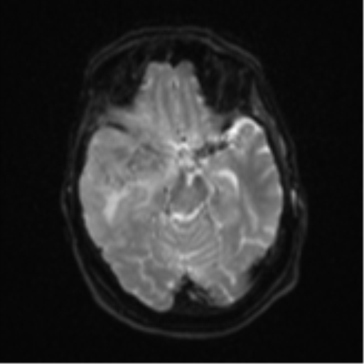 Atypical meningioma (WHO Grade II) (Radiopaedia 54742-60979 Axial DWI 11).png