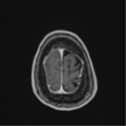 Atypical meningioma (WHO Grade II) (Radiopaedia 54742-60979 Axial T1 C+ 61).png