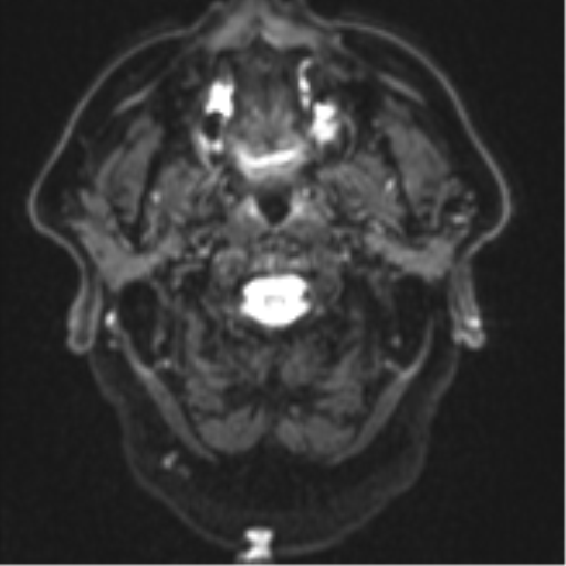 Atypical meningioma (WHO grade II) with brain invasion (Radiopaedia 57767-64729 Axial DWI 1).png